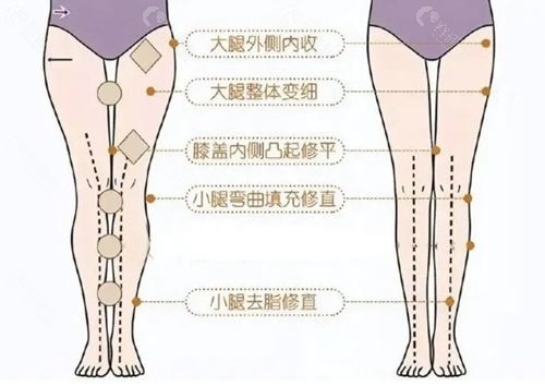 全国o型腿矫正排行榜前十 全国o型腿矫正排行榜前十
