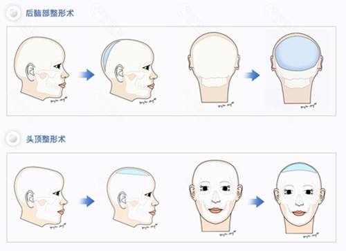 韩国雕刻整形外科医院骨水泥填充颅顶