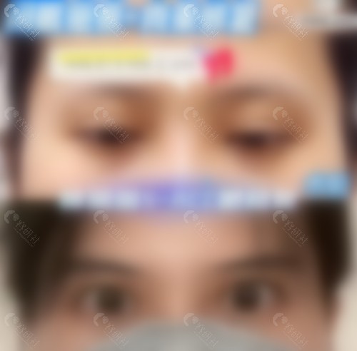 北京丰联丽格师丽丽双眼皮修复真人实例