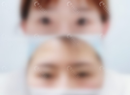 北京丰联丽格师丽丽双眼皮前后对比图