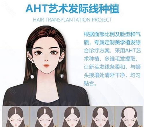 熙朵李会民植发AHT艺术发际线种植怎么样？