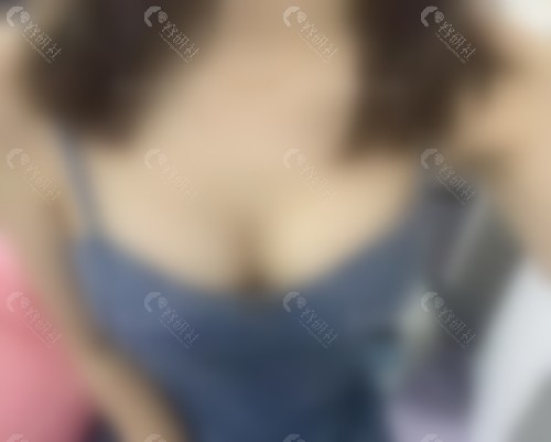 尹卫东隆胸真人实例