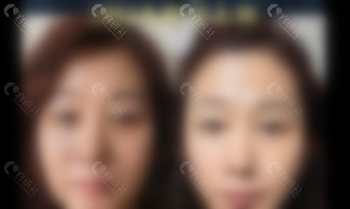 谭永嘉面部提升手术价格表
