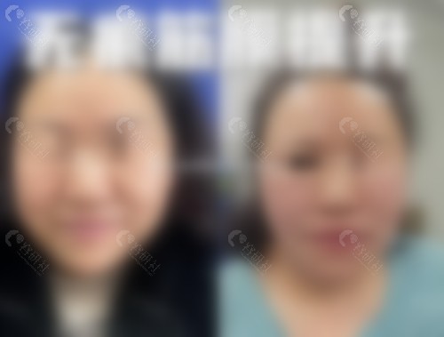 李建钢做筋膜提升手术真人实例