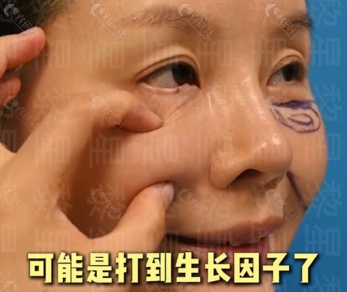 黎星生长因子取出费用