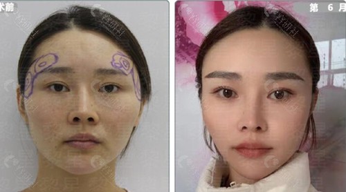 黎星生长因子取出术后评价