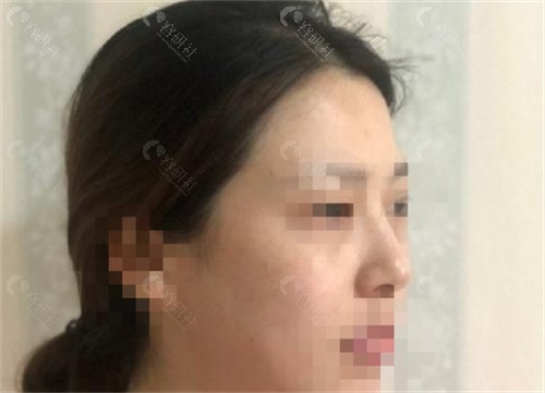 黄开亮做的鼻子实例