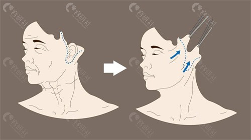 无痕筋膜悬吊除皱术操作流程