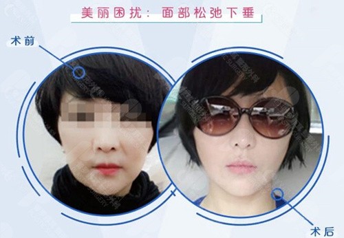 韩国普罗菲耳整形外科