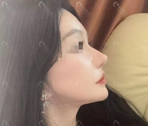 东莞西妃刘波做鼻子真人实例