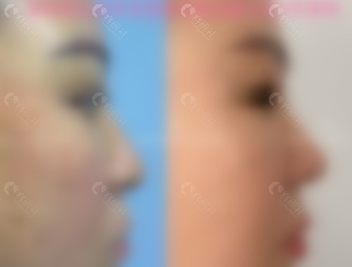 曾熬医生隆鼻收费价格表