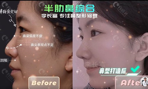 2024北京李长富做鼻子收费价格