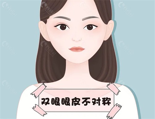  郑州聂丽丽做双眼皮做的咋样 