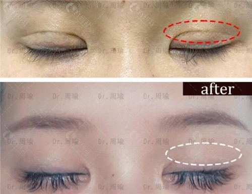 双眼皮疤痕修复真人实例