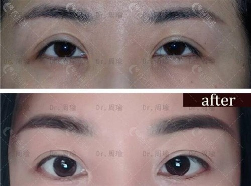 双眼皮高难度眼修复前后对比图