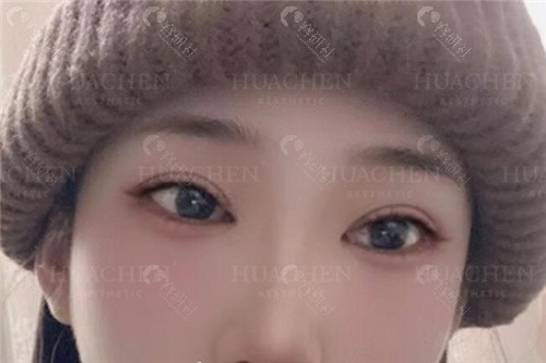 谭章梅双眼皮修复真人实例