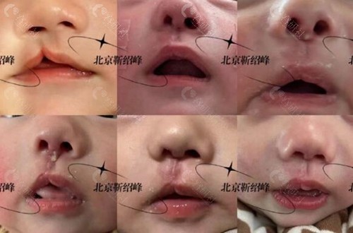靳绍锋医生做唇腭裂手术怎么样？