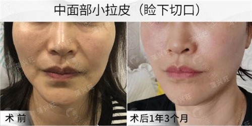 蒲兴旺医生做下睑拉皮手术价格表