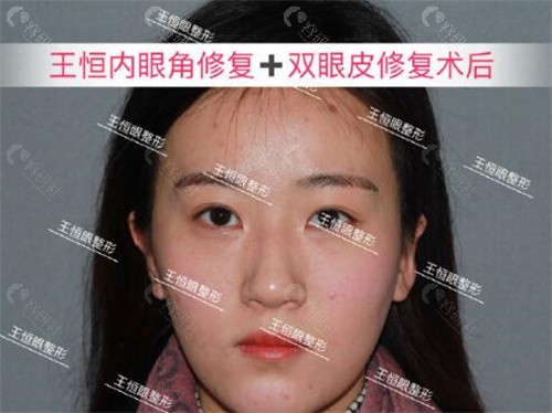 北京睐美安王恒做眼修复手术真人实例