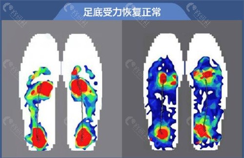 陈圣英医生做大脚骨手术价格
