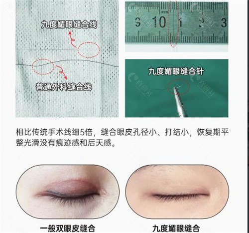 焦圆华医生双眼皮修复收费价格表