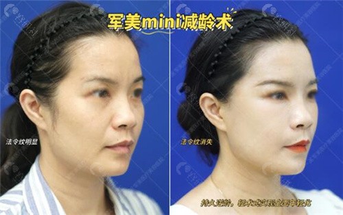 广州王世虎医生拉皮手术真人实例分享