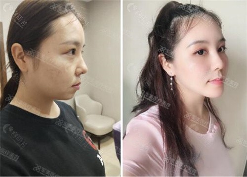 广州王世虎医生拉皮手术预约挂号