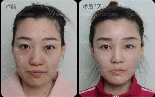 北京艺美王东做不开刀降颧骨手术真人实例