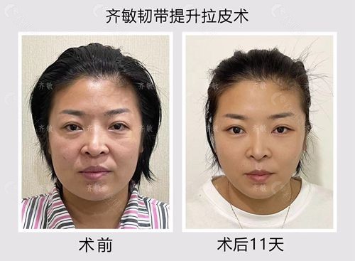北京齐敏医生韧带提升拉皮手术前和术后11天图片