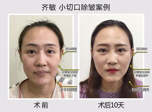 北京齐敏医生小切口除皱术前和术后10天图片