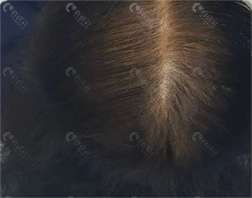 西班牙特思嘉生发素价格多少？