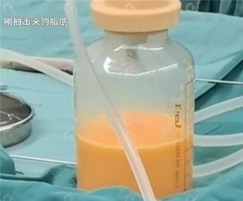 广州李方伟医生做富贵包手术价格