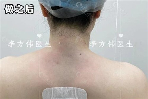广州李方伟医生做富贵包手术真人实例