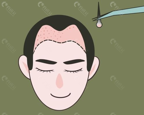 赣州小森林植发怎么样？