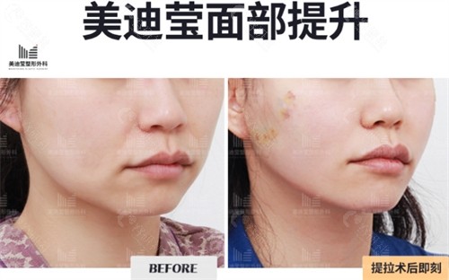 韩国美迪莹埋线提升前后对比图