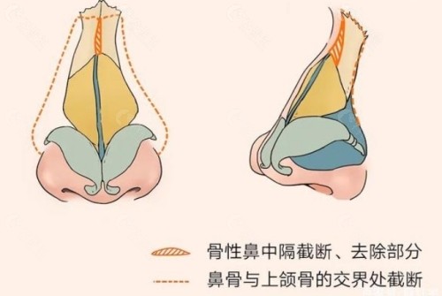 重度鼻中隔肋骨鼻修复优势