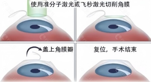 2024郑州近视眼手术价格表