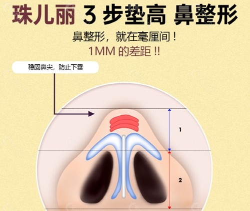 韩国珠儿丽整形外科鼻尖整形好吗