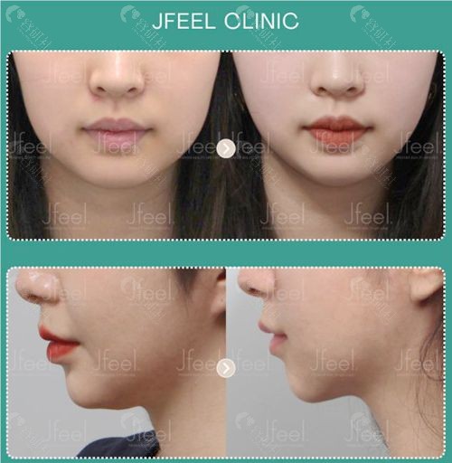 韩国JFeel皮肤科院长怎么样？
