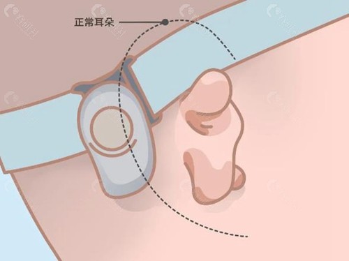 全包法耳再造手术怎么做