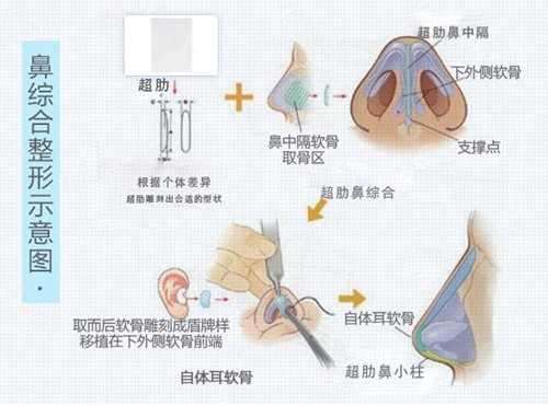 超肋舒铂和肋骨鼻的原理对比