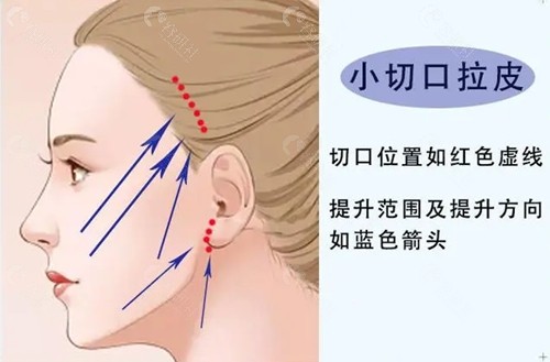 拉皮手术剥离范围越大越好吗