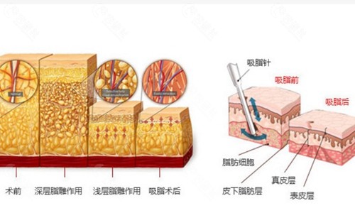 吸脂模拟图