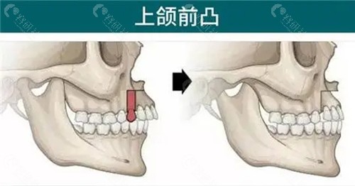 正颌手术价格