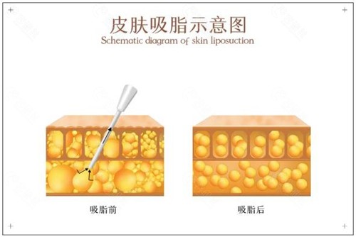 西安吸脂手术有哪些方法？