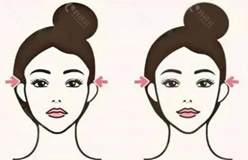 玻尿酸丰太阳穴的注意事项