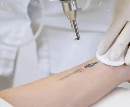 医院洗纹身挂什么科？