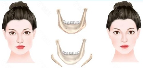 下颌角补骨操作流程