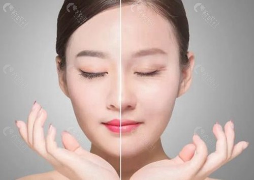 筋膜悬吊提眉和普通提眉区别一览