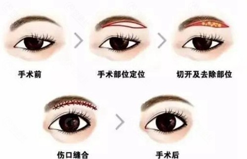 筋膜悬吊提眉和普通提眉哪个好？